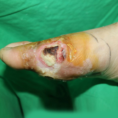 足部潰瘍的危險因子