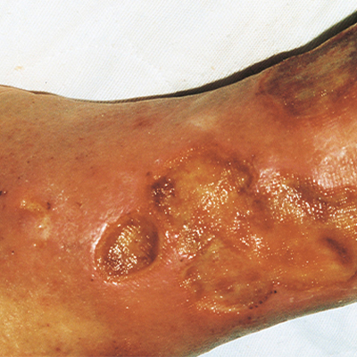足部潰瘍的危險因子